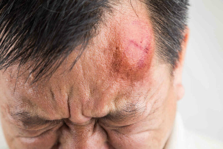 head injury concussion
