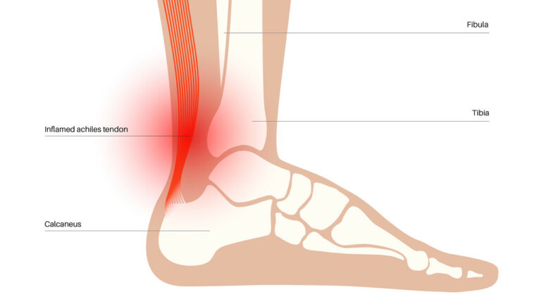 running and achilles tendinitis edmonton south